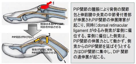 指穴|ボタン穴変形の治療と手術｜大阪の南川整形外